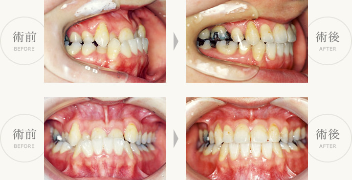 永久歯反対咬合症例（受け口）術前・術後