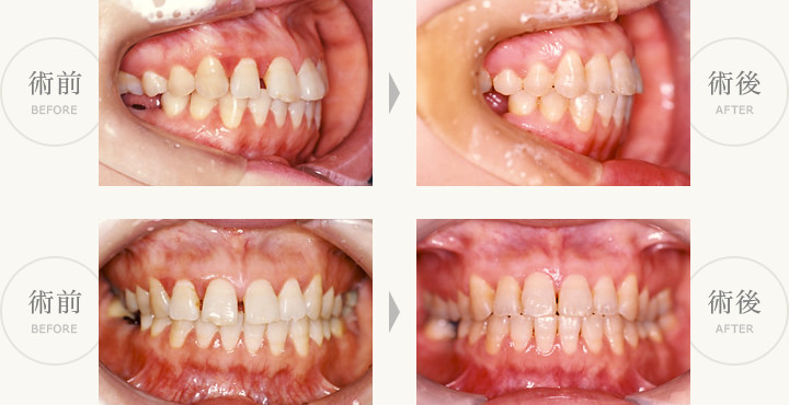 部分矯正症例（すき歯、上顎前歯の空隙閉鎖）術前・術後