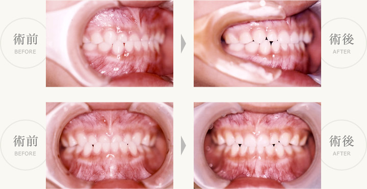 乳歯の反対咬合症例  術前・術後