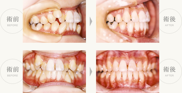 永久歯叢生症例（乱ぐい歯）術前・術後