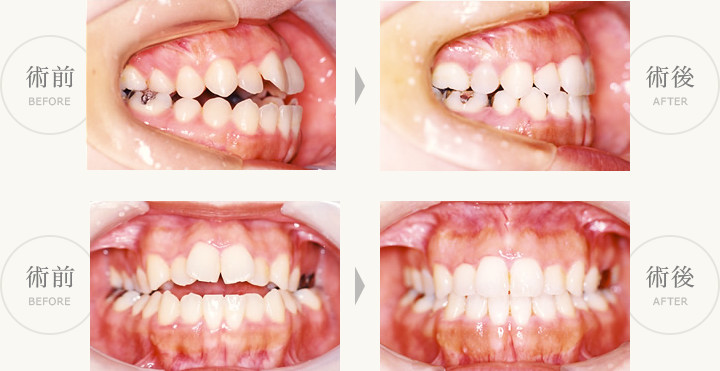 永久歯開咬合症例（舌のくせ）術前・術後