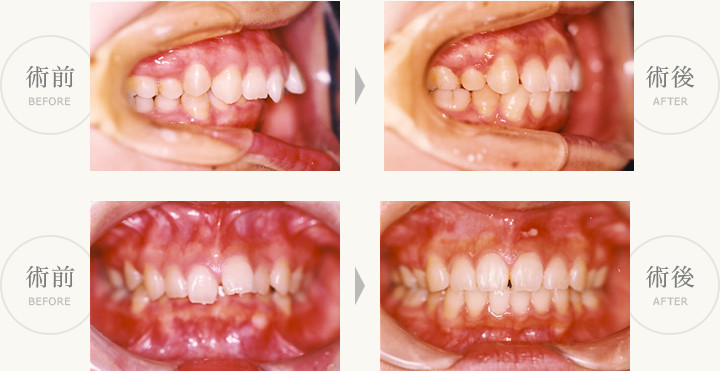 永久歯過蓋咬合症例  術前・術後