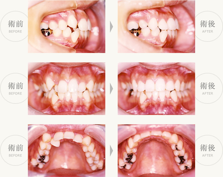 部分矯正症例（上顎前歯の凸凹の再配列）術前・術後