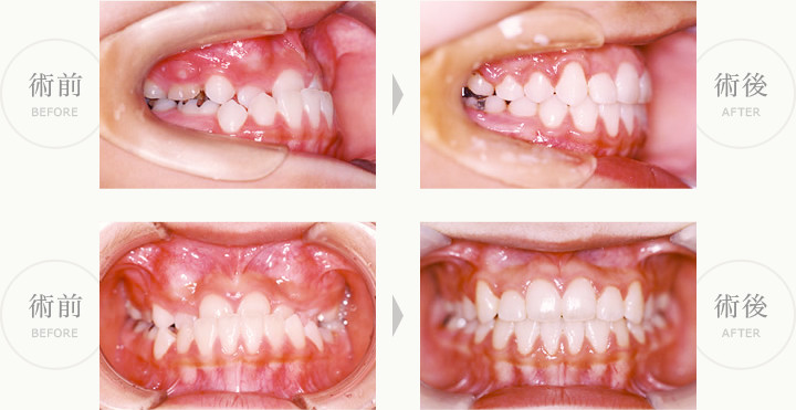 前歯部反対咬合症例（受け口）術前・術後